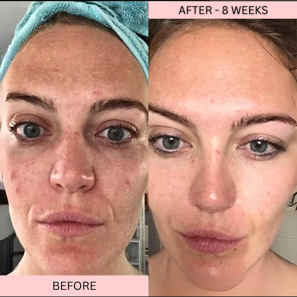 LowkClear Rejuvenate - 4 Color LED Mask